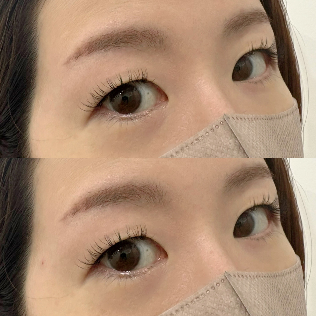 フラットラッシュ 一重